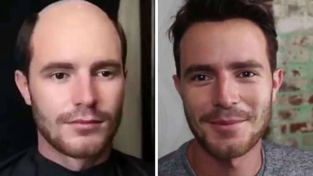 Muži mají zpět své ztracené vlasy 2
