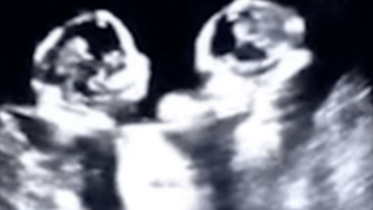 Ultrazvuk zachytil rvačku dvojčat v děloze 1