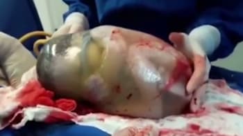 DRSNÉ VIDEO: Sestřička natočila vzácnou situaci, kdy se dítě narodilo uvnitř neporušené plodové blány!