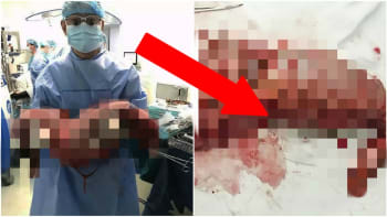 FOTO: Chirurgové vyoperovali pacientovi střevo plné výkalů. Nic šílenějšího dnes neuvidíte!