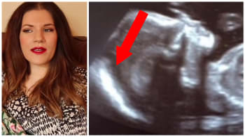 Dítě mělo na ultrazvuku podivnou záři kolem hlavy. Když žena porodila, lékaři zůstali v šoku! Co to bylo?