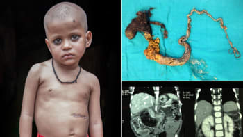 Děsivé! Lékaři odstranili ze žaludku čtyřletého chlapce 1,2 metru vlasů!