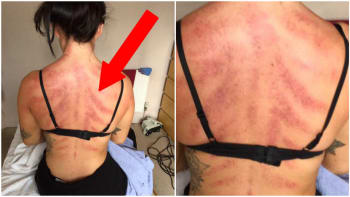 FOTO: Žena sdílela šokující fotky zranění z práce! Uhádnete, čím se živí?