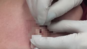 VIDEO pro otrlé: Nechutné vyoperování obří cysty prokáže odolnost vašeho žaludku!