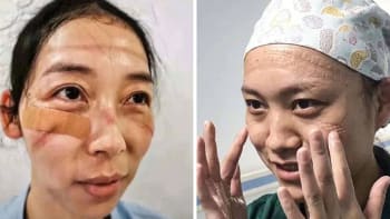 GALERIE: Čínské sestřičky sdílely, jak vypadají po boji s koronavirem. Jejich obličeje mluví za vše