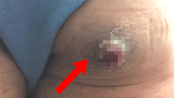 VIDEO: Žena měla na zadku tuto nechutnou cystu! Doktoři ji neodstranili a takhle odporně to dopadlo…