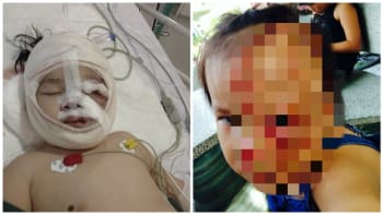 PŘÍBĚH: Malá holčička měla obrovský nádor na obličeji. Po úspěšné operaci vypadá takhle!