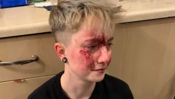 Lesbička sdílela brutální fotky obličeje po útoku homofobů. Co strašného jí udělali?