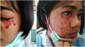 FOTO: Dívka pláče místo slz krev! Může za to tahle šílená choroba!