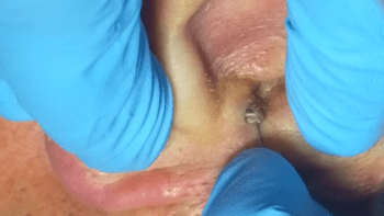 VIDEO: Muž měl zacpané ucho obřím humusem. Z jeho odstraňování se vám udělá zle