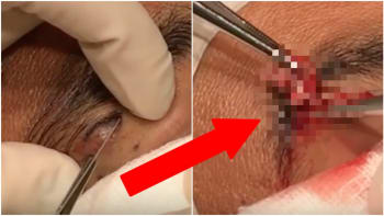 Týpkovi se udělala obří cysta nad levým okem! Doktorka její operaci zachytila na video, které vám zakroutí žaludkem!