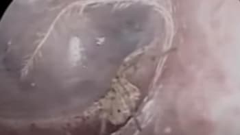 VIDEO: Lékaři našli pavouka uvnitř ženského ucha! Z těchto záběrů vám nebude dobře