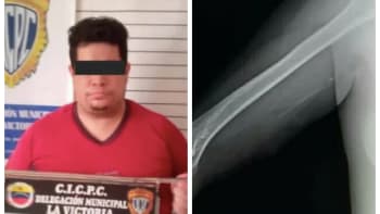 FOTO: Falešný doktor ženě implantoval pod kůži tyčinku od lízátka. Tvrdil, že to zabrání otěhotnění