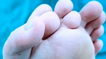 VIDEO: Muž měl na noze 9 prstů, lékaři museli část z nich odstranit! Jak vypadá chodidlo po operaci?