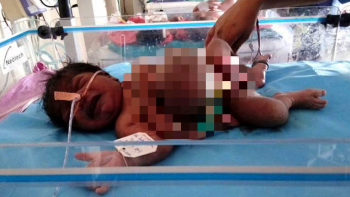 FOTO: Novorozenec má v břiše svého bráchu! Parazitické dvojče se teď doktoři pokusí odstranit…
