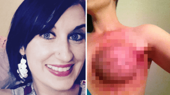 FOTO: Rakovina není sexy! Odvážná žena šla do boje proti hezkým kampaním, ukázala, jaké to je mít rakovinu prsu!