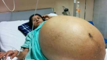 VIDEO: Mexičanka vážila 130 kilogramů a měla obří břicho. Když jí ho lékaři rozřízli, nemohli věřit vlastním očím! Byl tam...