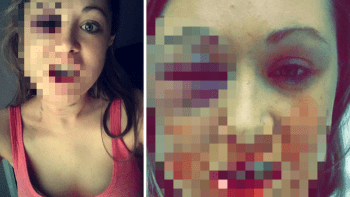 GALERIE: Odmítla sex, přítel ji zbil do bezvědomí! Žena zveřejnila fotky krvavých ran. Muž skončí…