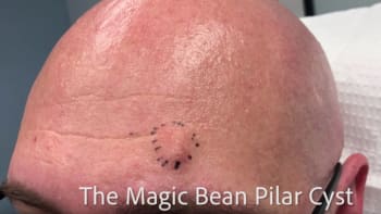 VIDEO: Muž měl na hlavě cystu ve tvaru obří fazole. Její vymáčknutí prověří odolnost vašeho žaludku