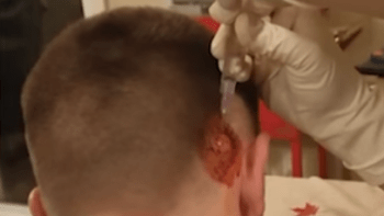 VIDEO: Muži rostla několik let na hlavě obří cysta. Její vymačkávání otestuje odolnost vašeho žaludku