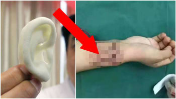 BIZÁR: Muž přišel během děsivé nehody o ucho. Nové mu vypěstovali přímo na jeho ruce! Podívejte se na něj!