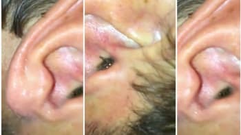VIDEO: Sledujte hrozivé záběry pavouka vylézajícího chlápkovi z ucha