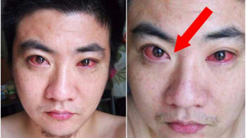 PŘÍBĚH: Muž onemocněl rakovinou očí a podle lékařů si za to mohl sám, protože se díval do...