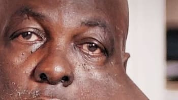 VIDEO: Doktoři odstranili jeden z největších nádorů na obličeji v historii! Podívejte se, jak muž vypadal předtím