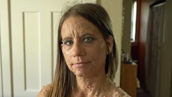 GALERIE: Lékaři odstranili ženě z obličeje stovky nádorů, které děsily lidi. Její proměna po operaci vám vyrazí dech