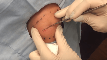 NECHUTNÉ VIDEO: Pacient měl obří cystu místo bicepsu! Doktorce se ji málem nepodařilo vymáčknout