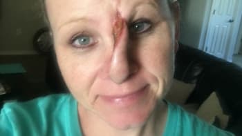 GALERIE: Žena skončila s dírou v nose poté, co ji operovali kvůli rakovině kůže. Tohle se může stát i vám