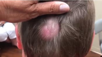 VIDEO: Muž měl ve vlasech skrytou obří cystu. Její vymáčknutí vám připomene vaječný salát