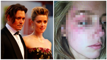 FOTO: Pirát Johnny Depp mlátil Amber Heard? Herečka ukázala u soudu tvář plnou modřin!