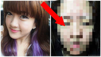 DĚSIVÉ FOTO: Blogerka si nechala ošetřit pleť. Na tváři jí z toho vyskákal tenhle hnus!