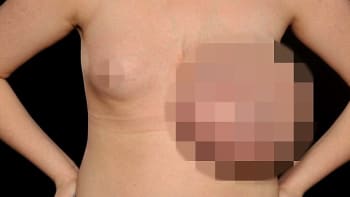 STRAŠLIVÝ PŘÍBĚH: Třináctiletá dívka měla v prsu nádor o velikosti ragbyového míče!
