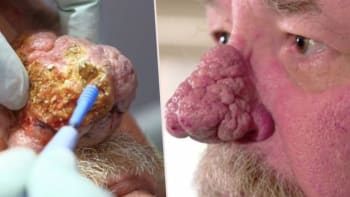 NECHUTNÉ VIDEO: Muž má na nose obří cystu, která děsí jeho vnoučata! Z jejího odstraňování vám bude blbě