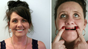 FOTO: Zubař řezník! Žena si šla nechat spravit jeden zub, po narkóze se probudila bezzubá!