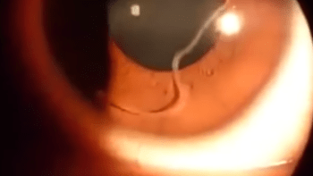 VIDEO: V oku ženy se zabydlel živý parazit. Podívejte se na nechutné detailní záběry