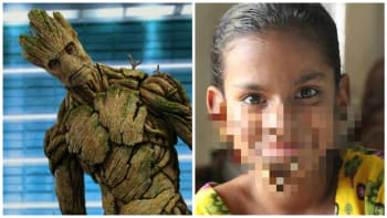 GALERIE: Stane se z ní Groot? Malá dívka trpí vzácnou nemocí, kvůli které jí rostou na obličeji kořeny!