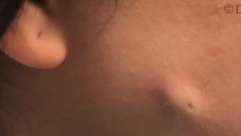 VIDEO: Žena měla na obličeji dvouhlavou cystu. Její vymáčknutí vás uspokojí a zároveň vám zvedne žaludek