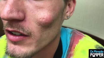 VIDEO: Muž měl na tváři cystu ve tvaru obřího vejce! Z jejího vymačkávání se vám zaručeně zvedne žaludek