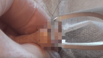 NECHUTNÉ VIDEO: Lékař mu praskl obří cystu na varlatech! Bez umrtvení…