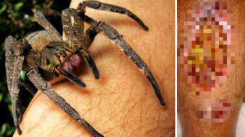 ŠÍLENÉ FOTO: Muž po pavoučím kousnutí málem přišel o nohu. Neuvěříte, kde na pavouka natrefil…