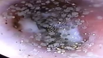 VIDEO: Žena šla k lékaři s bolestí v uchu. Ukázalo se, že jí v něm rostou houby. Tohle se může stát i vám!