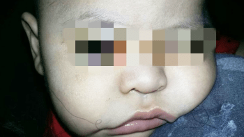 OTŘESNÉ: Chirurg odstranil ročnímu dítěti zdravé oko místo nemocného. Teď je zcela slepé