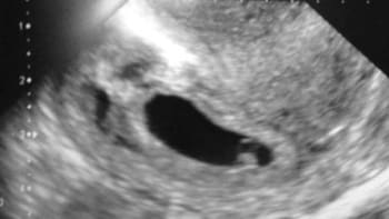Hrůzostrašný ultrazvuk: Pozor Vřískot útočí!