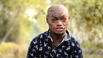 VIDEO: Hadí muž musí kvůli vážné nemoci každý týden svléknout kůži. Jaký je život s takovým tělem?