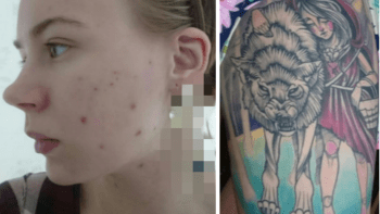 FOTO: Tahle dívka se nemůže přestat škrábat! Jizvy si kryje tetováním, podívejte se, jak se jí to daří…