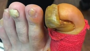 VIDEO: Doktor odstranil muži nehet z palce u nohy, který vypadal jako beraní roh. Tenhle hnus vám hne žlučí
