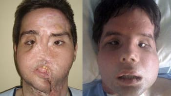 KRUTÁ GALERIE: 10 fotek lidí před a po transplantaci obličeje. Jaké horory dokáže spravit plastická operace?